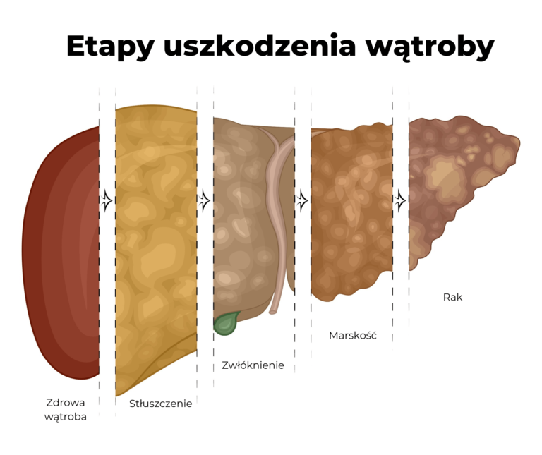 Marskość wątroby Objawy diagnostyka i dieta