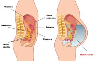 Wodobrzusze – zalecenia żywieniowe wodobrzusze