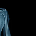 osteoporoza ipp
