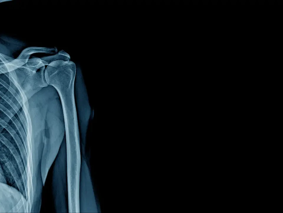osteoporoza ipp